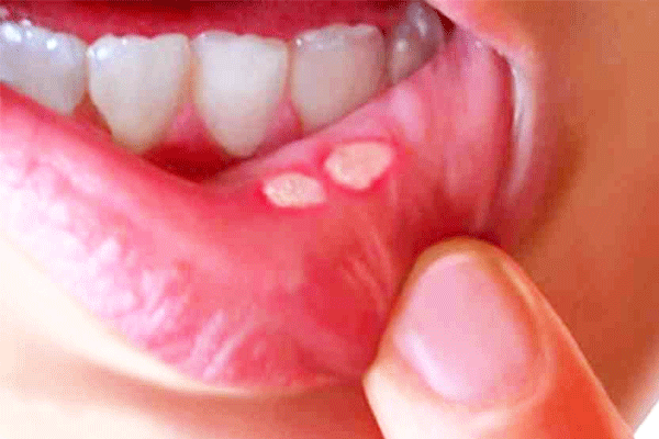 Mouth Cancer Ke Kya lakshan Hote hai | मुह के  Cancer के  लक्षण